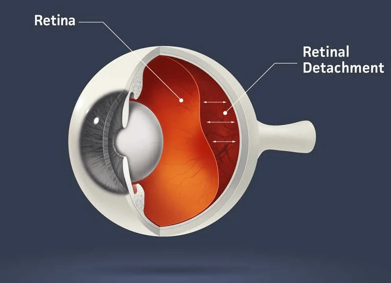 Retinal Detachment Image