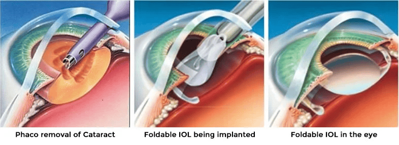 Phaco removal to IOL implantation steps