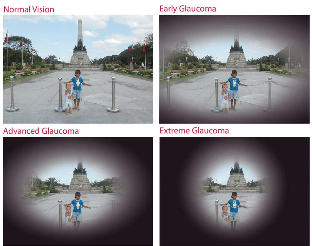Glaucoma vision progression
