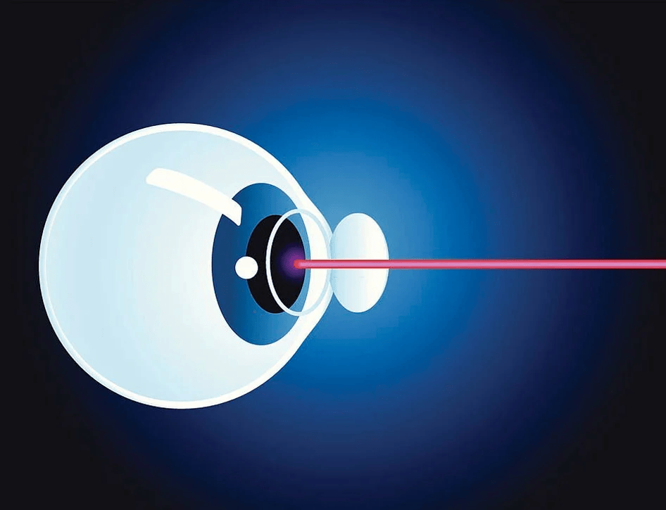 Laser Eye Procedure