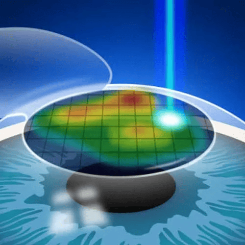 Ultimate Waveform LASIK