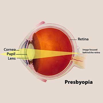 Cataract